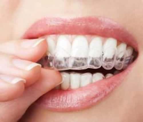 Are Invisalign braces affordable?