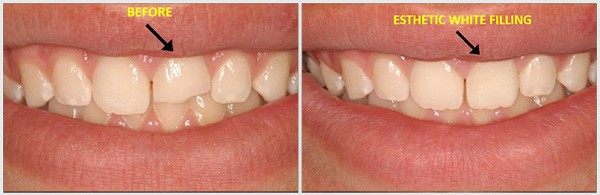 The Teeth Before And After Esthetic White Filling