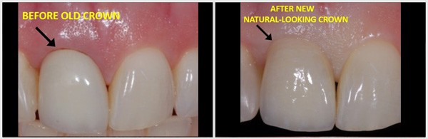 Before And After New Natural Looking Crown