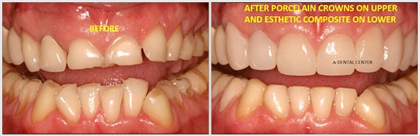 Before And After Porcelain Crowns, Esthetic Composite Treatment