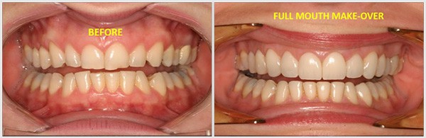 The Full Mouth Make Over A-Dental Center