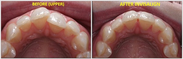 Appearance Of Teeth Before And After Invisalign