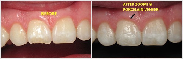 The Teeth Before And After Zoom, Porcelain Veneer