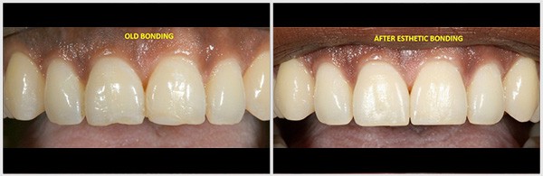 Old Bonding And After Esthetic Bonding Of Teeth