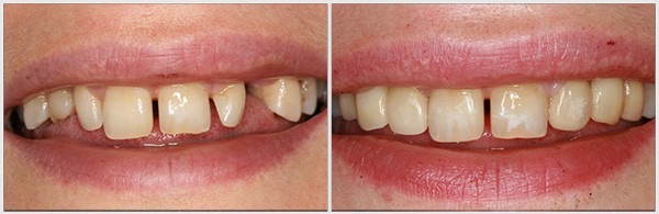 The Teeth Appearance Before And After Treatment