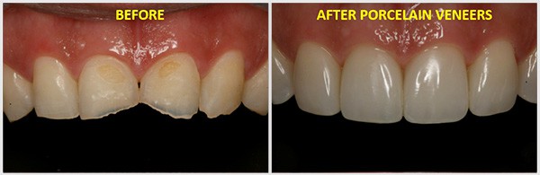 The Teeth Images Before And After Porcelain Veneers