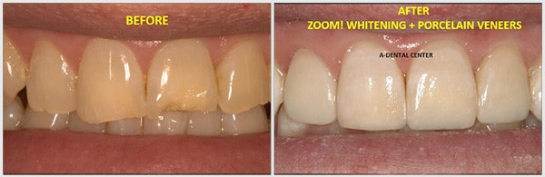 Tooth After The Zoom Whitening And Porcelain Veneers