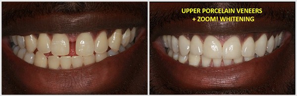 Upper Porcelain Veneers And Zoom Whitening Of The Teeth