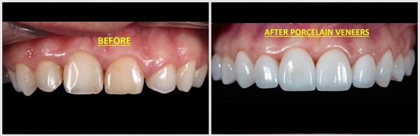 White Teeth After Porcelain Veneers