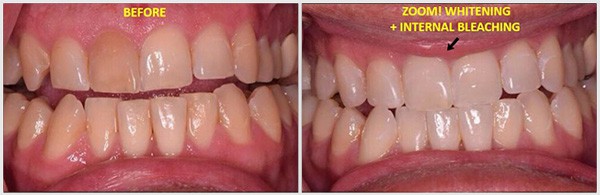 Teeth Before And After Zoom Whitening And Internal Bleaching