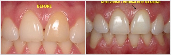 Teeth Before And After Zoom, Internal Deep Bleaching