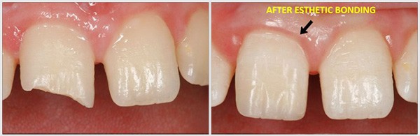 The Esthetic Bonding Teeth A-Dental Center
