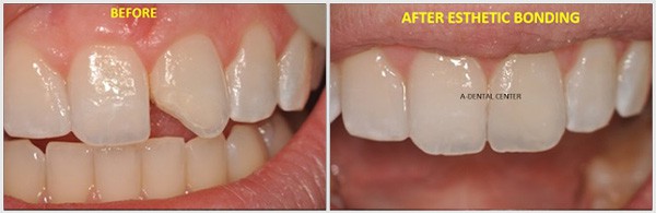 The Teeth Before And After Undergoing Esthetic Bonding
