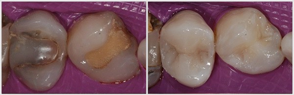 The Teeth Appearance Before And After The Fillings