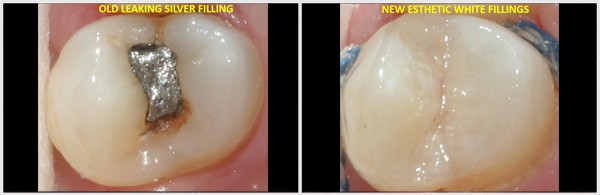 Old Silver Fillings And New Esthetic White Fillings