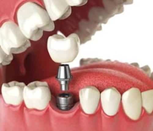 The best dental implants