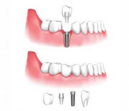 Close up graphic of a dental implant