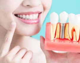 The Dental Implants Process A-Dental Center
