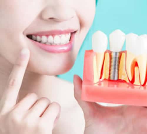 The Dental Implants Process A-Dental Center