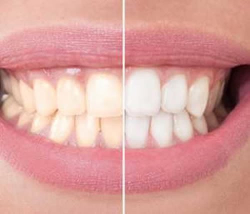 Dramatic results after tooth whitening