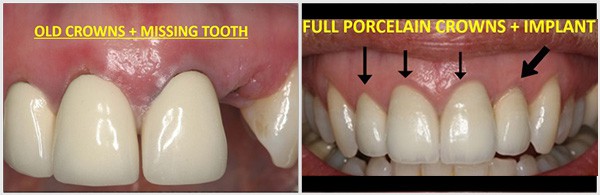 The Full Porcelain Crowns And Implant