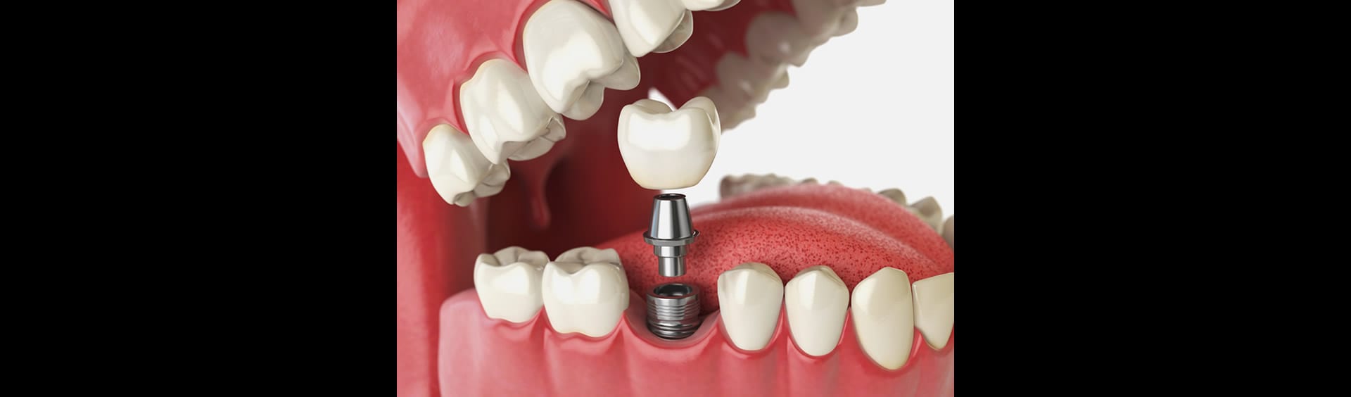 A-Dental Center - A Complete Guide to Permanent Tooth Replacement with Dental Implants