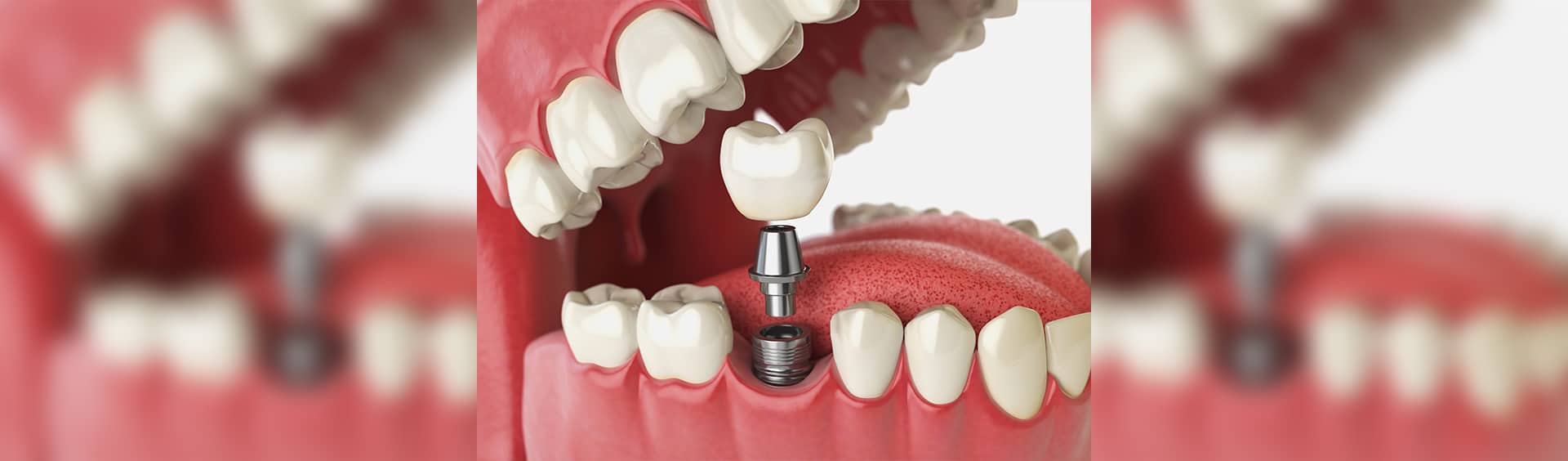 A-Dental Center - Benefits of Dental Implants Over Other Tooth Replacement Options