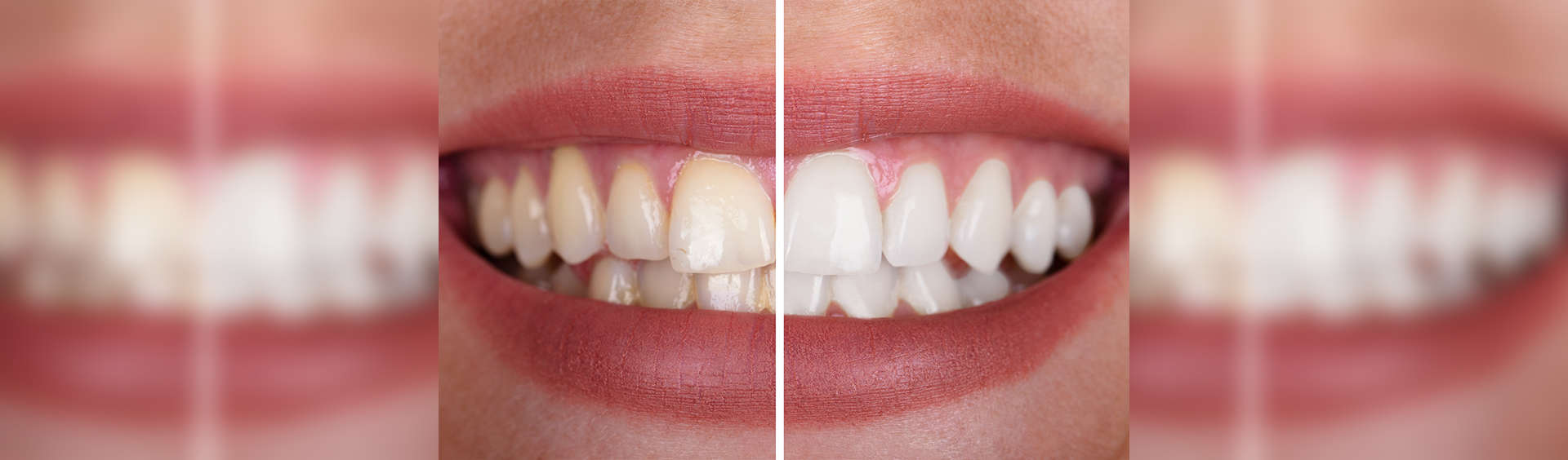 A-Dental Center - tooth whitening
