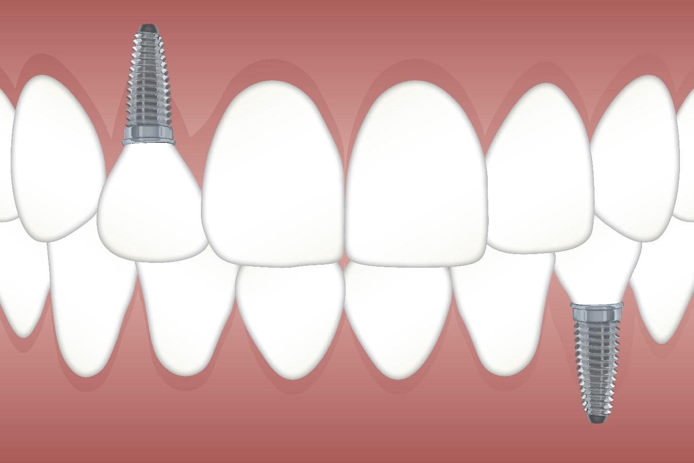 A-Dental Center - dental implant procedure