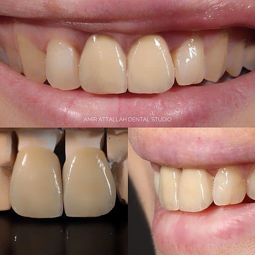 A-Dental Center - Dental crown procedure