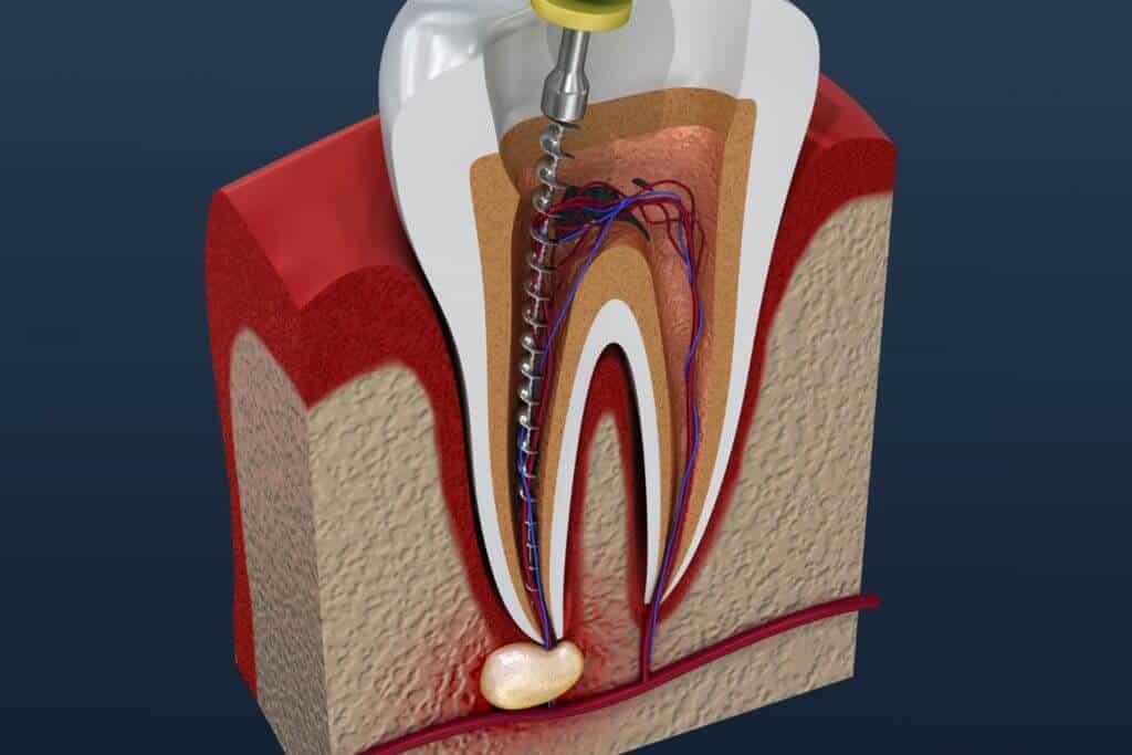 A-Dental Center - What do you do after a root canal