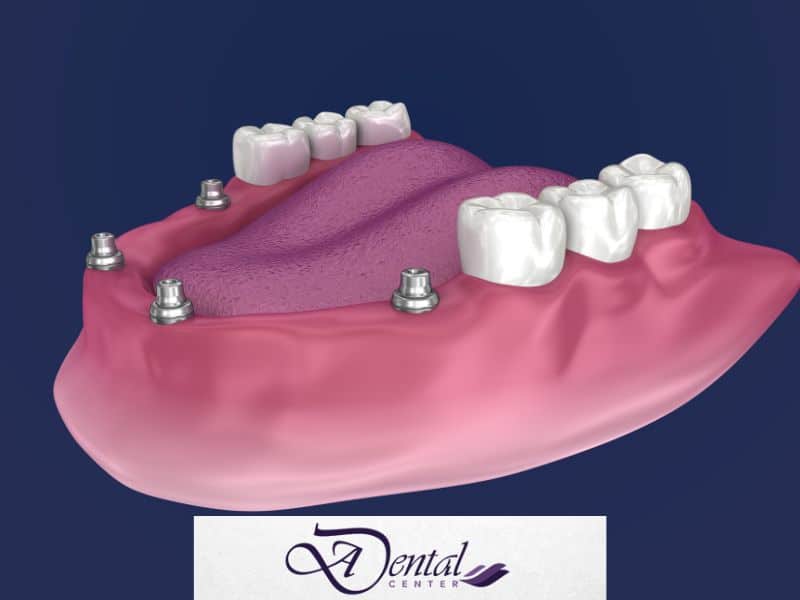 All-On-4 Removable Implant-Supported Dentures