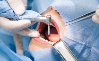 What Is the Procedure Behind a Dental Implant?